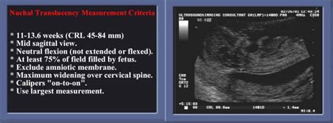 nuchal fold thickness measurement at 14 weeks|20 week anatomy scan measurements.